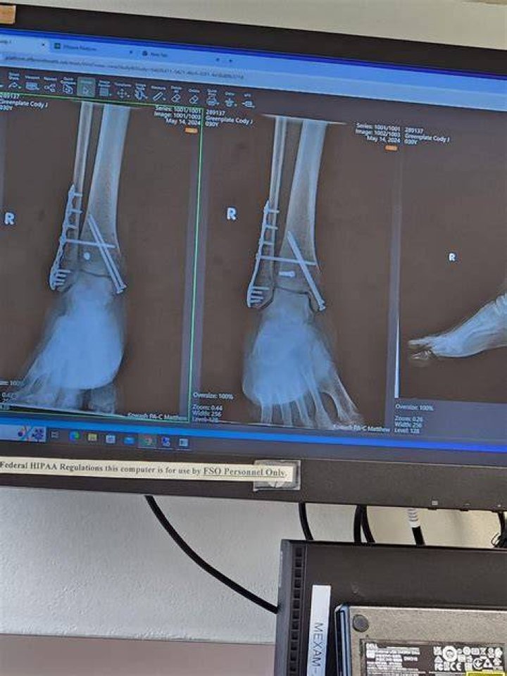 Can I sleep without my walking boot?