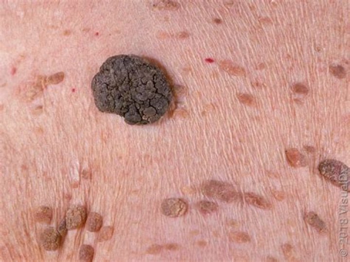 Can seborrheic keratosis look like melanoma?