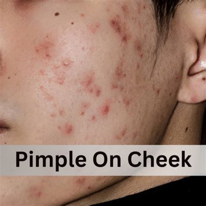 Do all pimples come to a head?