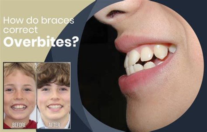 Do braces have a taste?