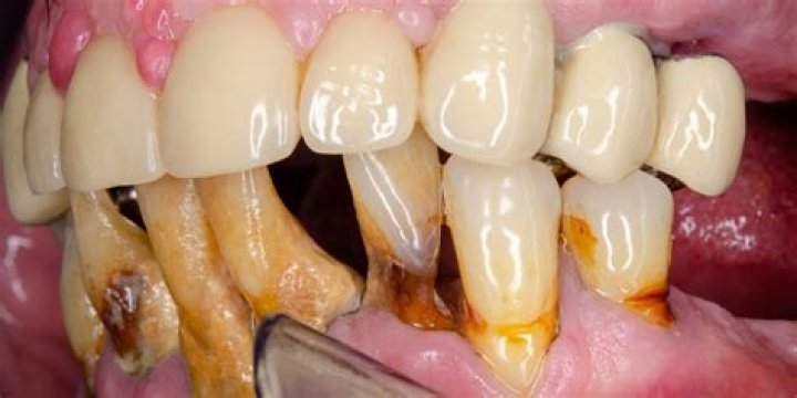 Does Clorox damage teeth?