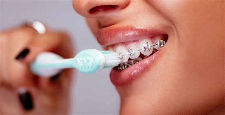 How often brush teeth with braces?