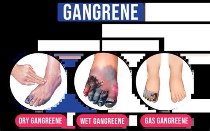 What color is gangrene?