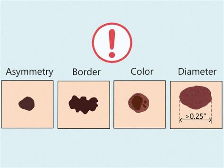 What does a mole on breast mean?