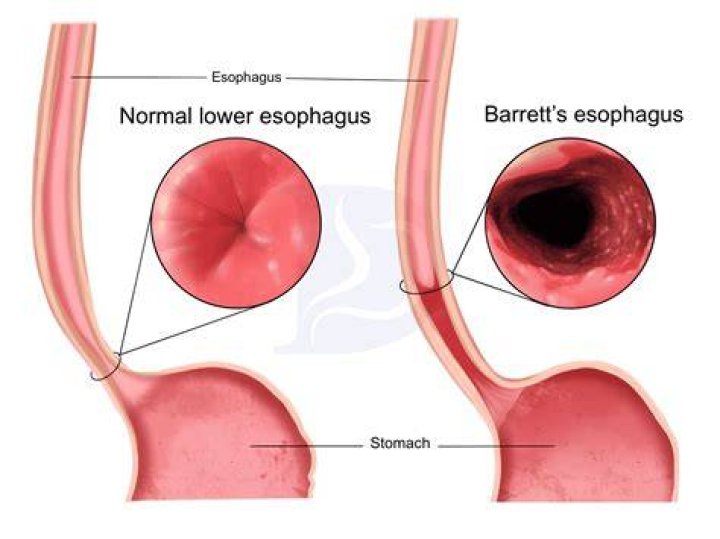 What does pill esophagitis feel like?
