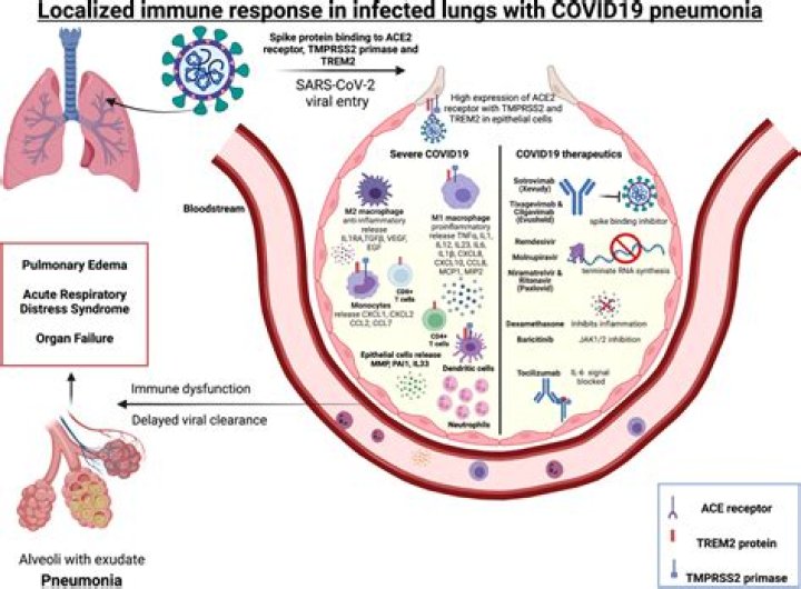 What is severe Covid pneumonia?