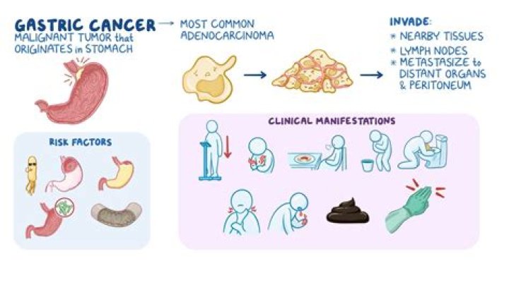 What is the most common presenting symptom of gastric cancer?