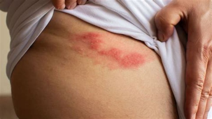 What triggers shingles outbreak?