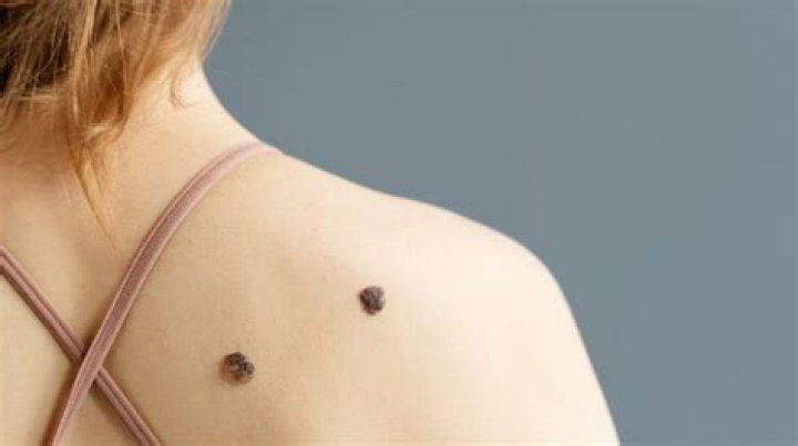When should I be concerned about a skin tag?