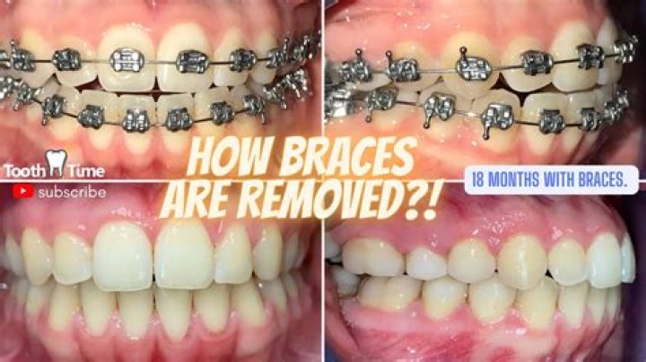Why are my teeth so big after braces?