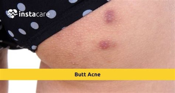 Why do girls get pimples?