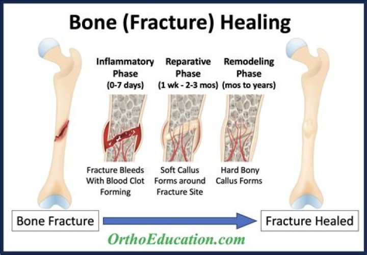 Why would a bone fracture not heal?